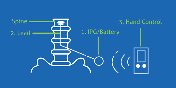 Spinal-cord stimulator parts